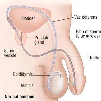 Male Infertility