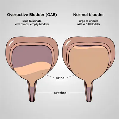 Overactive Bladder