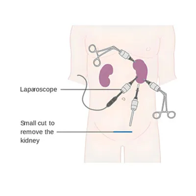 Nephrectomy