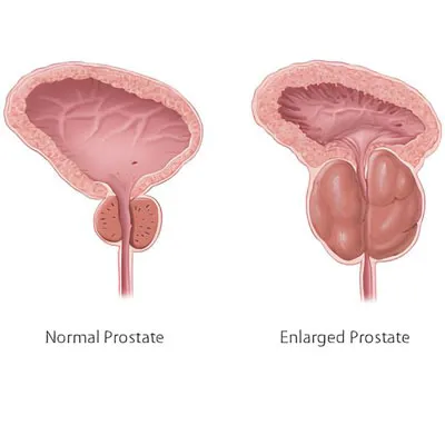 Enlargement of Prostate