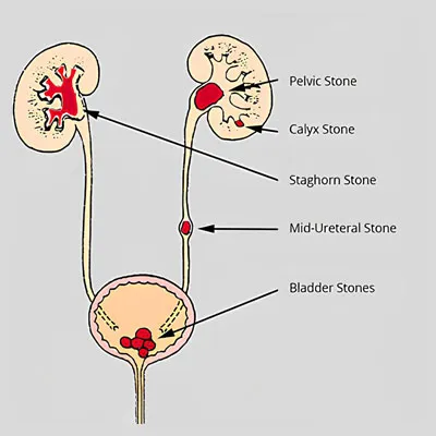 Urinary Stones