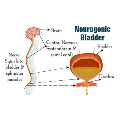 UDS for Neurogenic Bladder