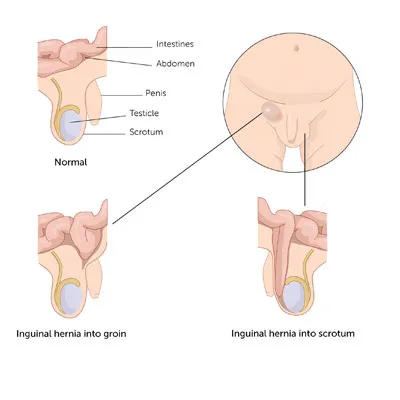 hernia