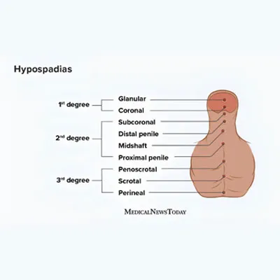 hypospadias