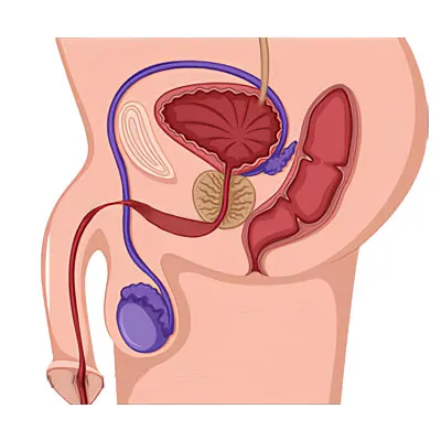 Urethral Stricture