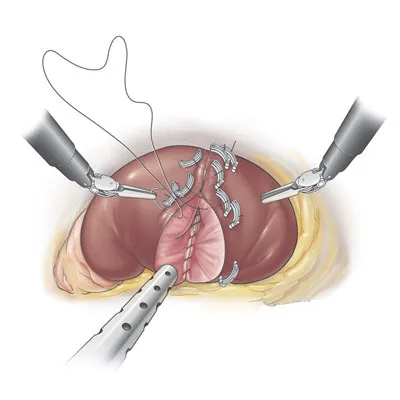 Robotic Nephrectomy