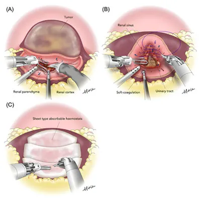 Robotic Partial Nephrectomy