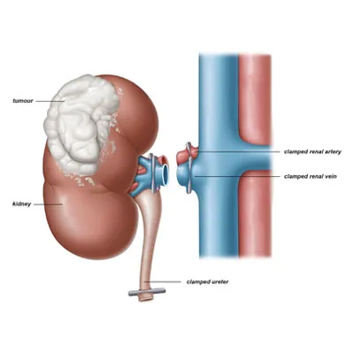 Robotic Radical Nephrectomy