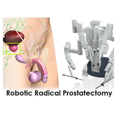 Prostatectomy