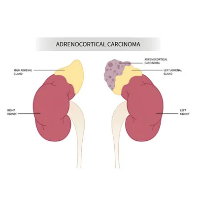 Adrenal Gland Cancer