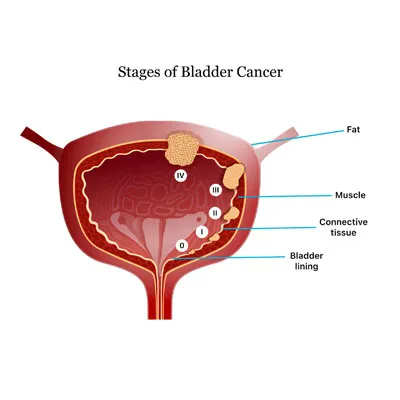 Bladder Cancer