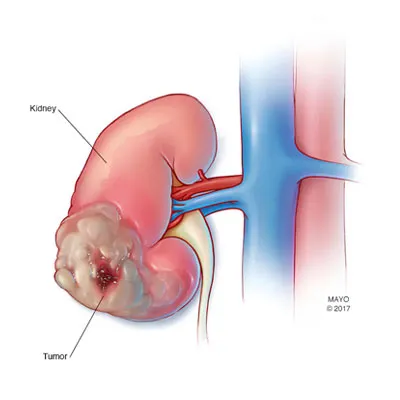 Kidney Cancer