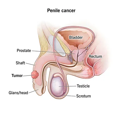 Penile Cancer