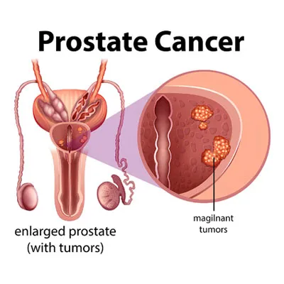 Prostate Cancer