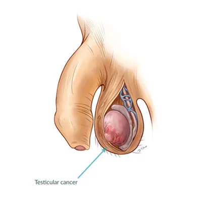 Testicular Cancer