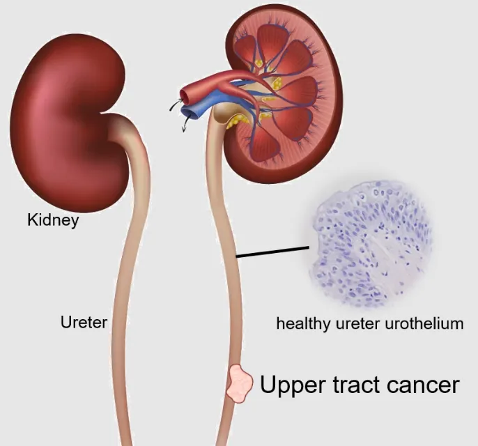 Ureter Cancer