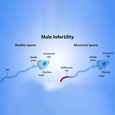 Male Infertility