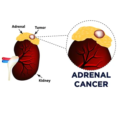 Adrenal Cancer