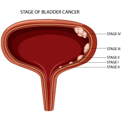 Bladder Tumor