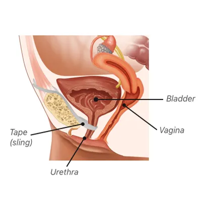 Bladder Sling Procedure