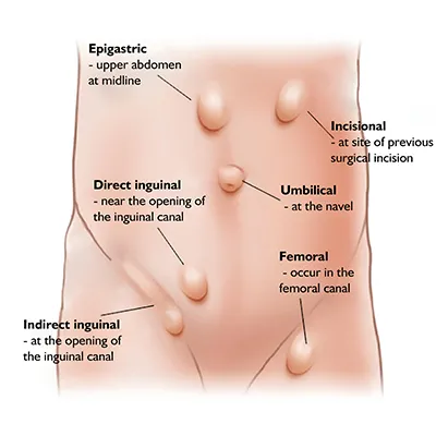 Pediatric Hernia Repair