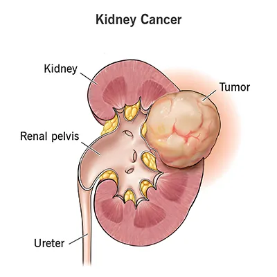 Kidney Cancer