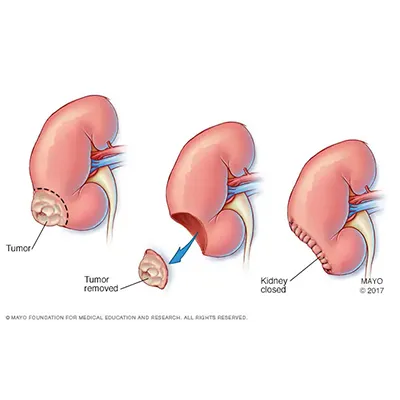 Nephrectomy