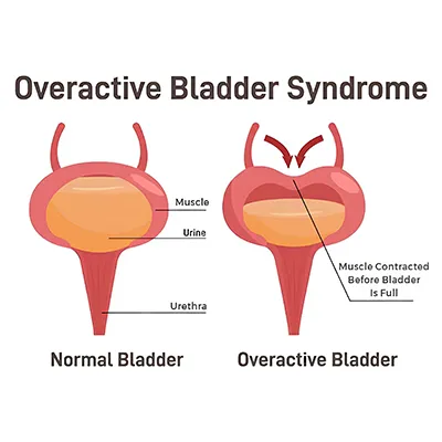 Overactive Bladder