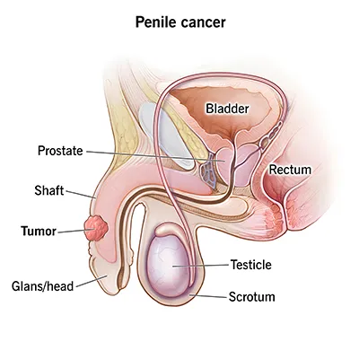 Penile Cancer