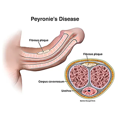 Peyronies Disease