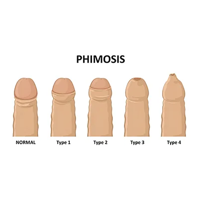 Phimosis