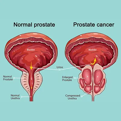 Radical Prostatectomy