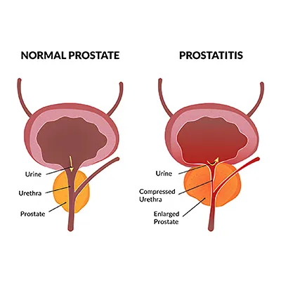 Prostatitis