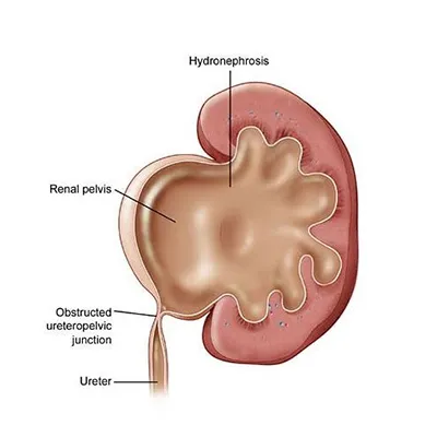 Pyeloplasty