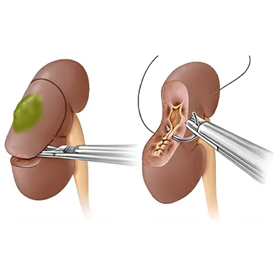 Robotic Nephrectomy