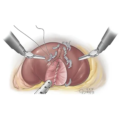 Robotic Partial Nephrectomy