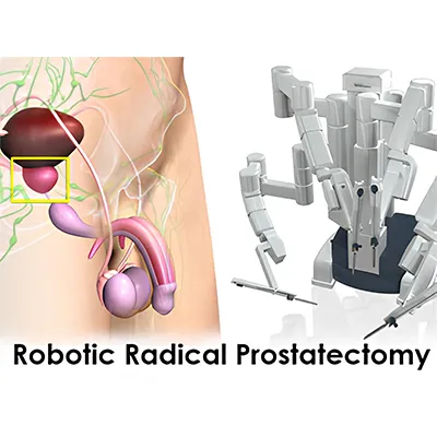 Robotic Radical Prostatectomy