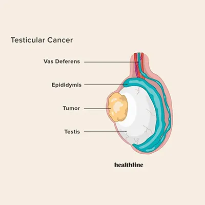 Testicular Cancer