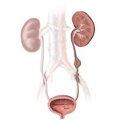 Ureter Cancer