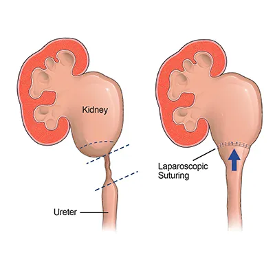 Urethral Stricture