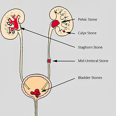 Ureteral Stone