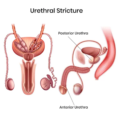 Urethral Stricture Disease