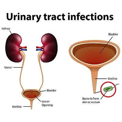 UTI