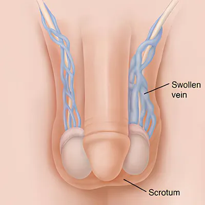 Varicocelectomy