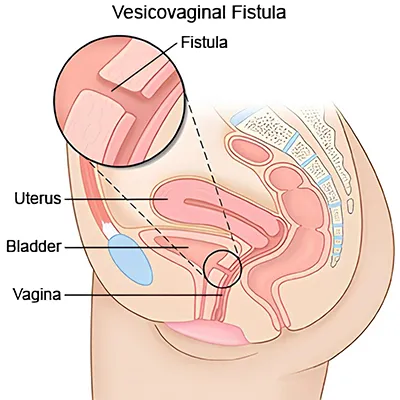 Vesicovaginal Fistula