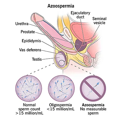 Zero Sperm Count